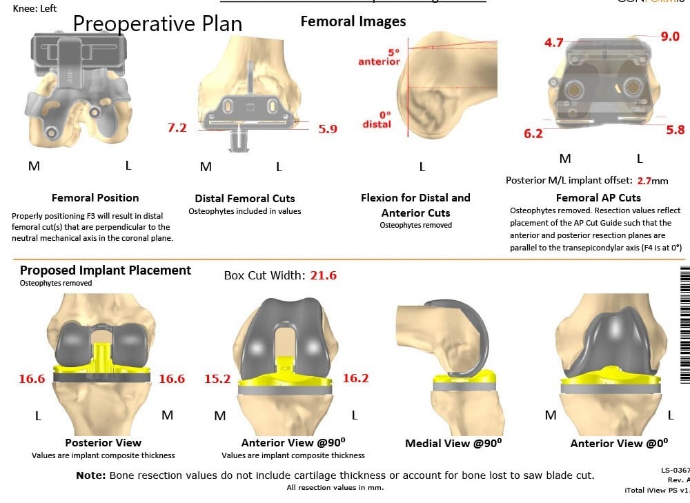 Complete Orthopedics patient specific surgical plan for a Custom Left Knee Replacement in a 71-year-old male - scan 2 Complete Orthopedics patient specific surgical plan for a Custom Left Knee Replacement in a 71-year-old male - scan 2