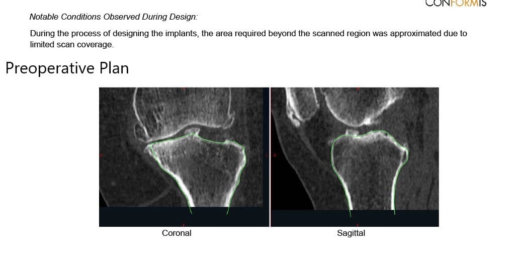 Complete Orthopedics patient specific surgical plan for a Custom Left Knee Replacement in a 71-year-old male - scan 3 Complete Orthopedics patient specific surgical plan for a Custom Left Knee Replacement in a 71-year-old male - scan 3