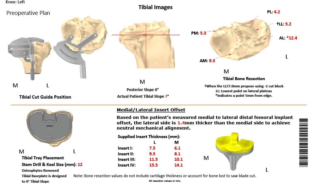 Complete Orthopedics patient specific surgical plan for a Custom Left Knee Total Replacement in a 68-year-old Female Complete Orthopedics patient specific surgical plan for a Custom Left Knee Total Replacement in a 68-year-old Female