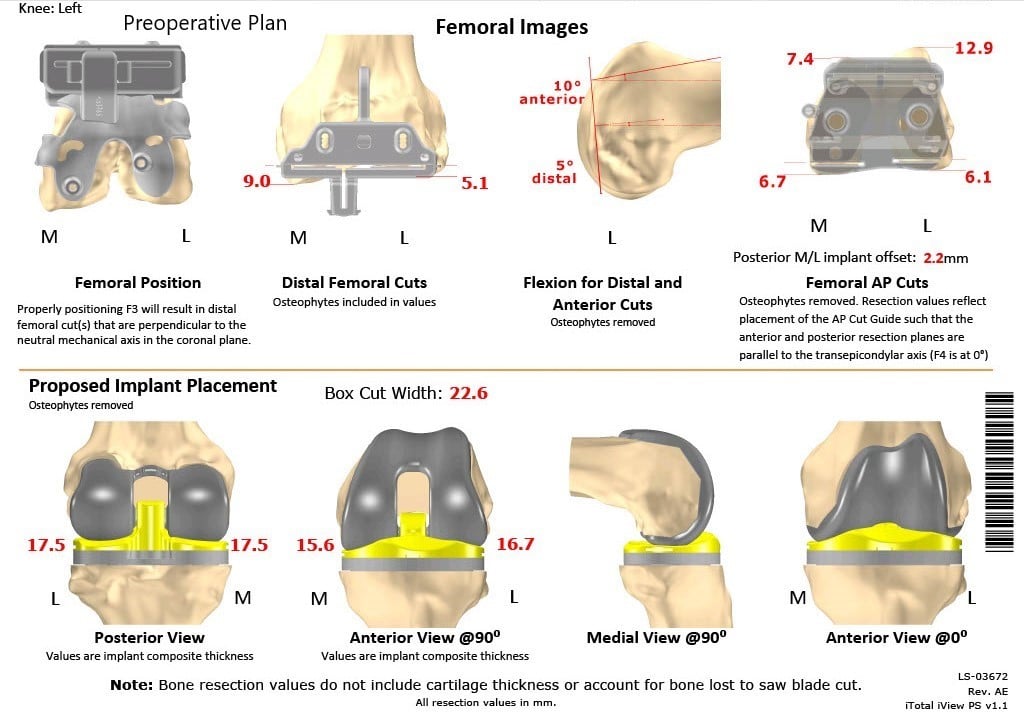 Complete Orthopedics patient specific surgical plan for a Custom Left Knee Total Replacement in a 68-year-old Female - scan 2 Complete Orthopedics patient specific surgical plan for a Custom Left Knee Total Replacement in a 68-year-old Female - scan 2