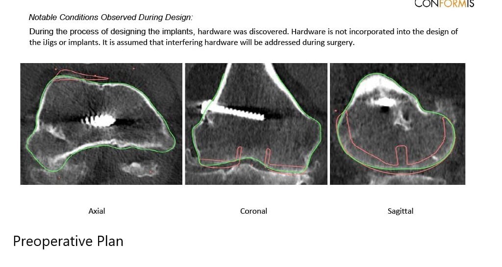 Preoperative X-ray showing the AP and lateral views of the right knee with retained screws consistent with ACL reconstruction - img 3 Preoperative X-ray showing the AP and lateral views of the right knee with retained screws consistent with ACL reconstruction - img 3