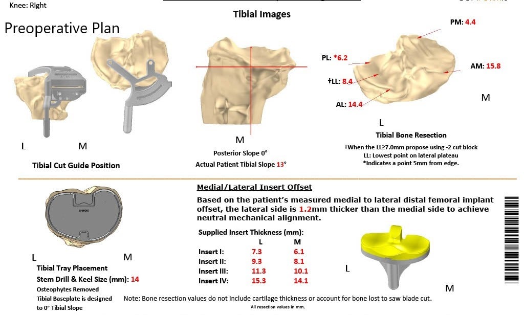 Complete Orthopedics patient specific surgical plan for a Custom Right Total Knee Replacement in a 55-year-old Female with Prior ACL Reconstruction Complete Orthopedics patient specific surgical plan for a Custom Right Total Knee Replacement in a 55-year-old Female with Prior ACL Reconstruction