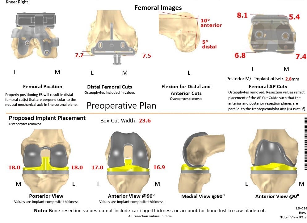 Complete Orthopedics patient specific surgical plan for a Custom Right Total Knee Replacement in a 55-year-old Female with Prior ACL Reconstruction - scan 2 Complete Orthopedics patient specific surgical plan for a Custom Right Total Knee Replacement in a 55-year-old Female with Prior ACL Reconstruction - scan 2