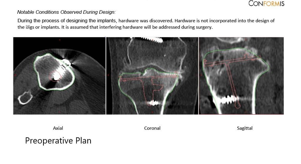 Preoperative X-ray showing the AP and lateral views of the right knee with retained screws consistent with ACL reconstruction - img 3 Preoperative X-ray showing the AP and lateral views of the right knee with retained screws consistent with ACL reconstruction - img 3