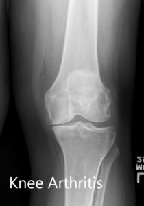 Preoperative X-ray of the left knee showing AP and lateral views