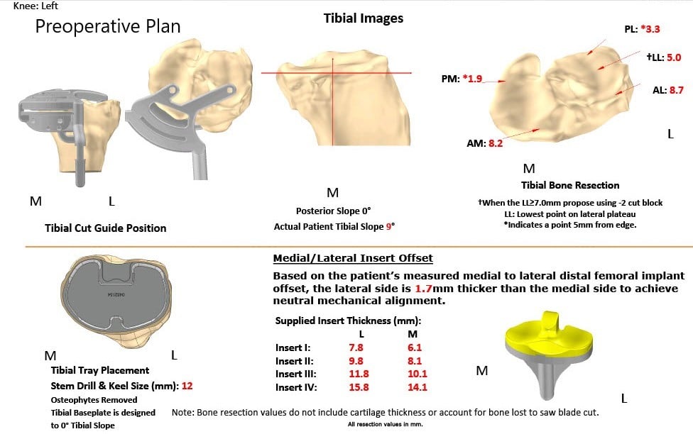 Complete Orthopedics patient specific surgical plan for a Customized Left Knee Total Replacement in a 66-year-old female Complete Orthopedics patient specific surgical plan for a Customized Left Knee Total Replacement in a 66-year-old female