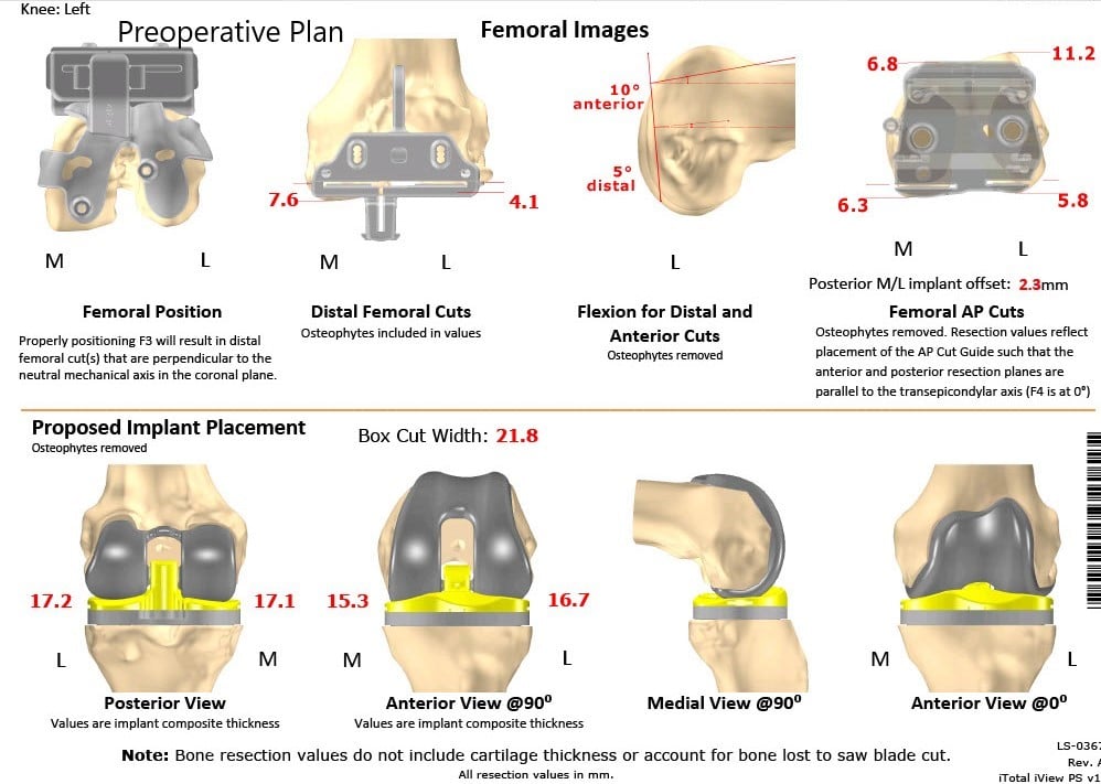 Complete Orthopedics patient specific surgical plan for a Customized Left Knee Total Replacement in a 66-year-old female - scan 2 Complete Orthopedics patient specific surgical plan for a Customized Left Knee Total Replacement in a 66-year-old female - scan 2