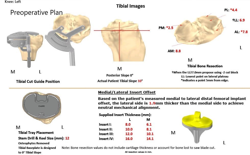 Complete Orthopedics patient specific surgical plan for a Customized Left Total Knee Replacement in a 73-year-old Male Complete Orthopedics patient specific surgical plan for a Customized Left Total Knee Replacement in a 73-year-old Male