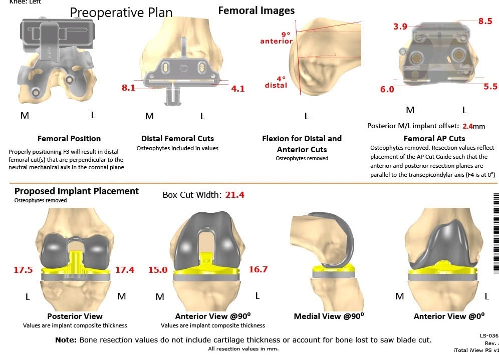 Complete Orthopedics patient specific surgical plan for a Customized Left Total Knee Replacement in a 73-year-old Male - scan 2 Complete Orthopedics patient specific surgical plan for a Customized Left Total Knee Replacement in a 73-year-old Male - scan 2