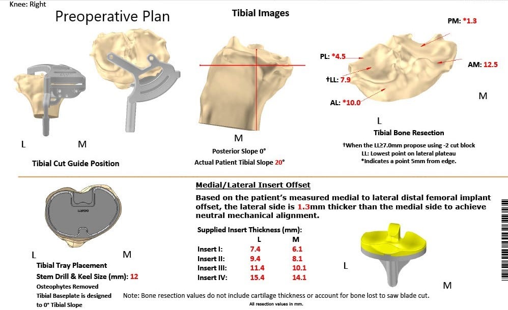 Complete Orthopedics patient specific surgical plan for a Customized Right Knee Replacement in a 72-year-old patient Complete Orthopedics patient specific surgical plan for a Customized Right Knee Replacement in a 72-year-old patient