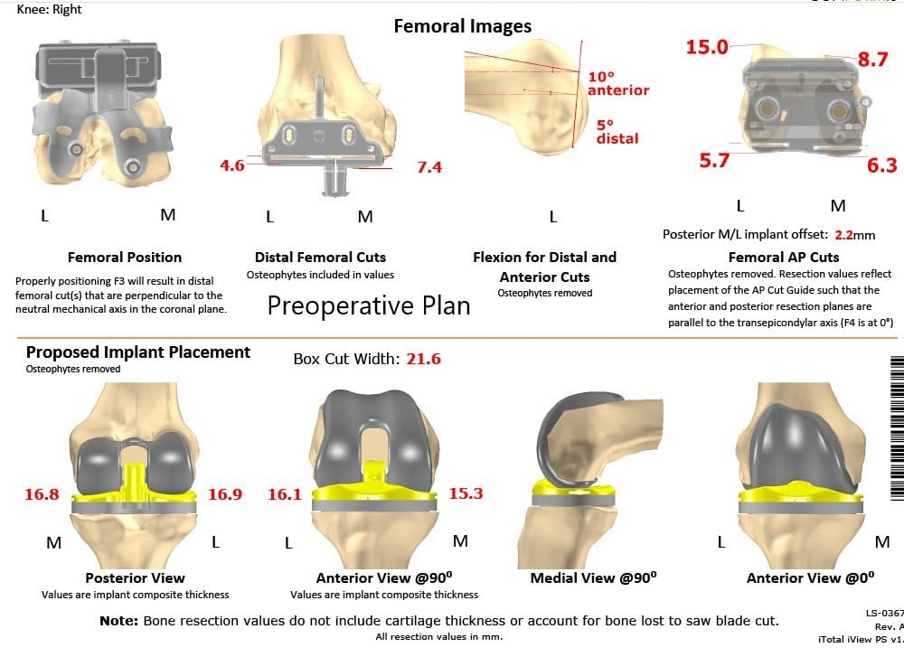 Complete Orthopedics patient specific surgical plan for a Customized Right Knee Replacement in a 72-year-old patient - scan 2 Complete Orthopedics patient specific surgical plan for a Customized Right Knee Replacement in a 72-year-old patient - scan 2