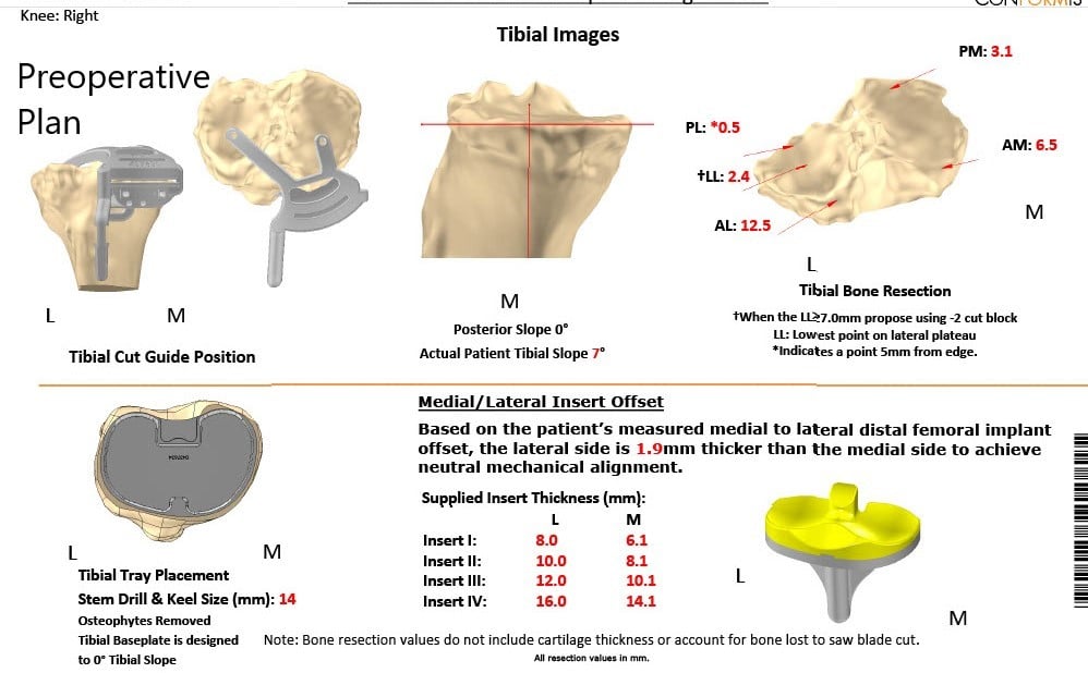 Complete Orthopedics patient specific surgical plan for a Customized Right Knee Replacement in a 65-year-old female Complete Orthopedics patient specific surgical plan for a Customized Right Knee Replacement in a 65-year-old female