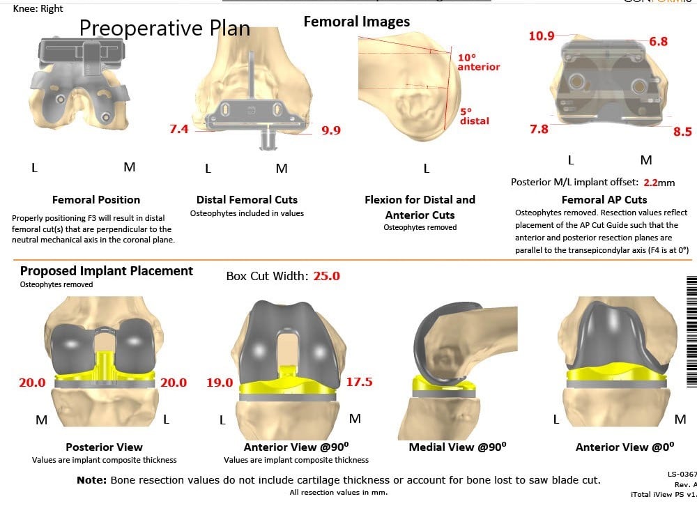 Complete Orthopedics patient specific surgical plan for a Customized Right Knee Replacement in a 65-year-old female - scan 2 Complete Orthopedics patient specific surgical plan for a Customized Right Knee Replacement in a 65-year-old female - scan 2