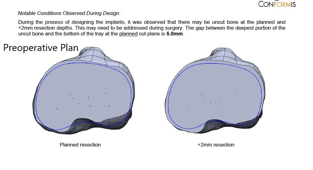 Complete Orthopedics patient specific surgical plan for a Customized Right Knee Replacement in a 65-year-old female - scan 3 Complete Orthopedics patient specific surgical plan for a Customized Right Knee Replacement in a 65-year-old female - scan 3