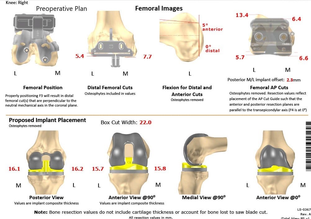 Complete Orthopedics patient specific surgical plan for a Customized Right Total Knee Replacement in a 73-year-old Male with Arthritis Complete Orthopedics patient specific surgical plan for a Customized Right Total Knee Replacement in a 73-year-old Male with Arthritis
