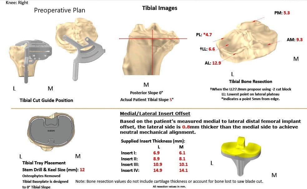 Complete Orthopedics patient specific surgical plan for a Customized Right Total Knee Replacement in a 73-year-old Male with Arthritis - scan 2 Complete Orthopedics patient specific surgical plan for a Customized Right Total Knee Replacement in a 73-year-old Male with Arthritis - scan 2