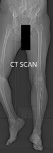Preoperative CT scan topography images 