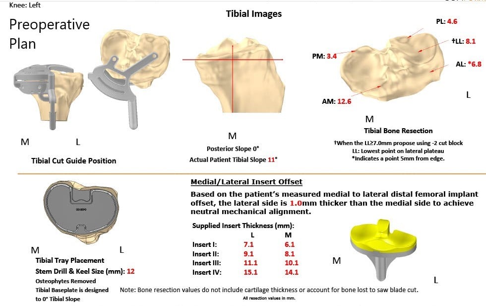 Complete Orthopedics patient specific surgical plan for a Left Custom Total Knee Replacement in a 74-year-old female Complete Orthopedics patient specific surgical plan for a Left Custom Total Knee Replacement in a 74-year-old female