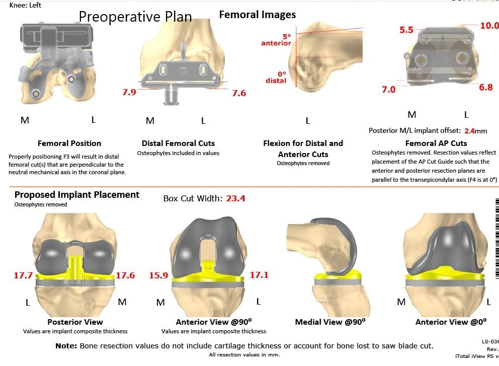 Complete Orthopedics patient specific surgical plan for a Left Custom Total Knee Replacement in a 74-year-old female - scan 2 Complete Orthopedics patient specific surgical plan for a Left Custom Total Knee Replacement in a 74-year-old female - scan 2