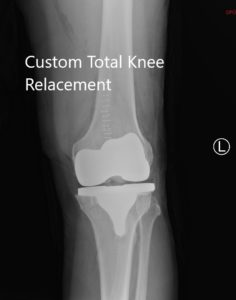 Postoperative X-ray of the left knee showing lateral and AP views - img 2