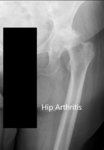 Radiografía preoperatoria de la cadera izquierda que muestra AP y vistas laterales