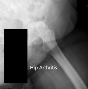 Radiografía preoperatoria de la cadera izquierda que muestra AP y vistas laterales - img 2