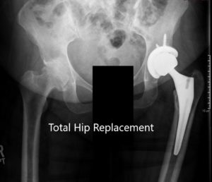 Radiografía postoperatoria que muestra la vista AP de la pelvis y la vista lateral de la cadera izquierda