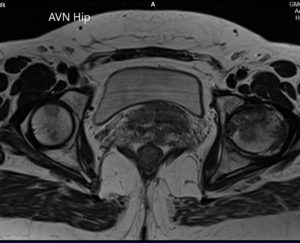 T1WI de la RM que muestra una sección axial de la cabeza femoral bilateral