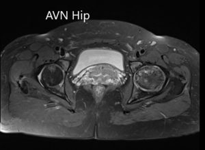 T2WI de la resonancia magnética que muestra una sección axial de la cabeza femoral bilateral