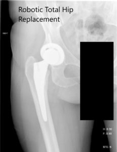 Postoperative X-ray of the right hip showing AP and lateral view