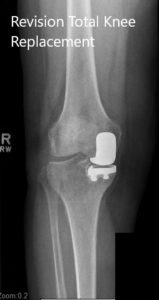 Preoperative X-ray of the right knee in anteroposterior and lateral views - img 2