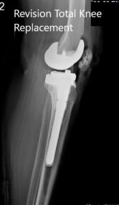 Postoperative X-ray showing the lateral and anteroposterior views of the right knee