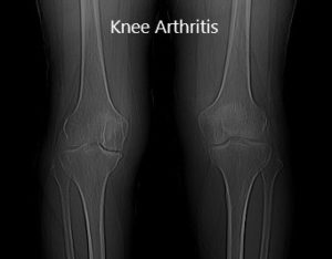 Preoperative X-ray showing AP view of the bilateral knee joints