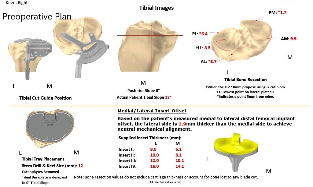 Complete Orthopedics patient specific surgical plan for a Right Custom Total Knee Replacement in a 68-year-old female Complete Orthopedics patient specific surgical plan for a Right Custom Total Knee Replacement in a 68-year-old female