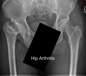 Preoperative X-ray showing the AP view of the pelvis with both hip joints