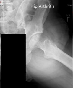 Preoperative X-ray of the left hip in AP and frog-legged lateral views - img 2