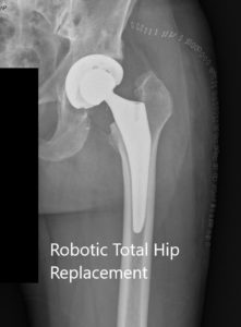 Postoperative X-ray of the left hip showing the AP and lateral views