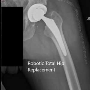Postoperative X-ray of the left hip showing the AP and lateral views - img 2