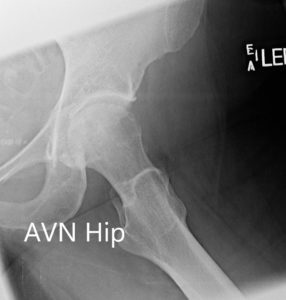 Radiografía que muestra la AP y las vistas laterales con patas de rana de la articulación de la cadera izquierda - img 2