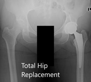 Radiografía postoperatoria de la pelvis que muestra AP y vistas laterales