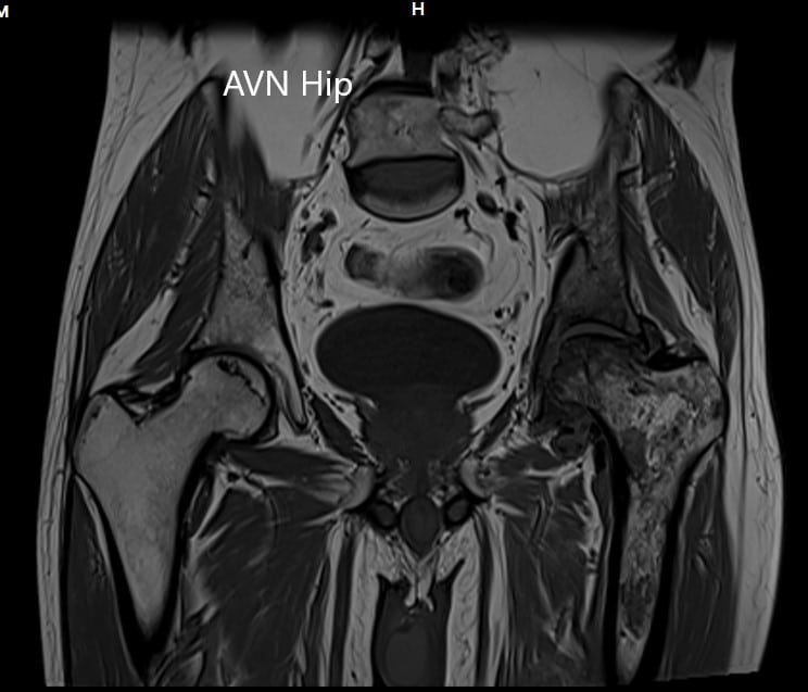 MRI showing the T1WI of the pelvis