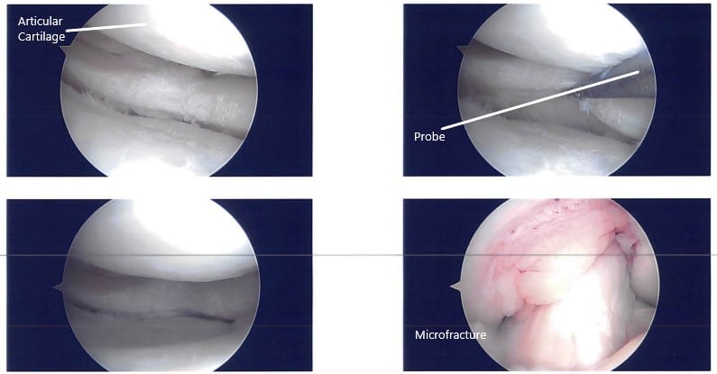 Imágenes artroscópicas intraoperatorias 3