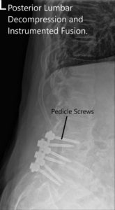 Postoperative X-ray showing AP and Lateral Views 2