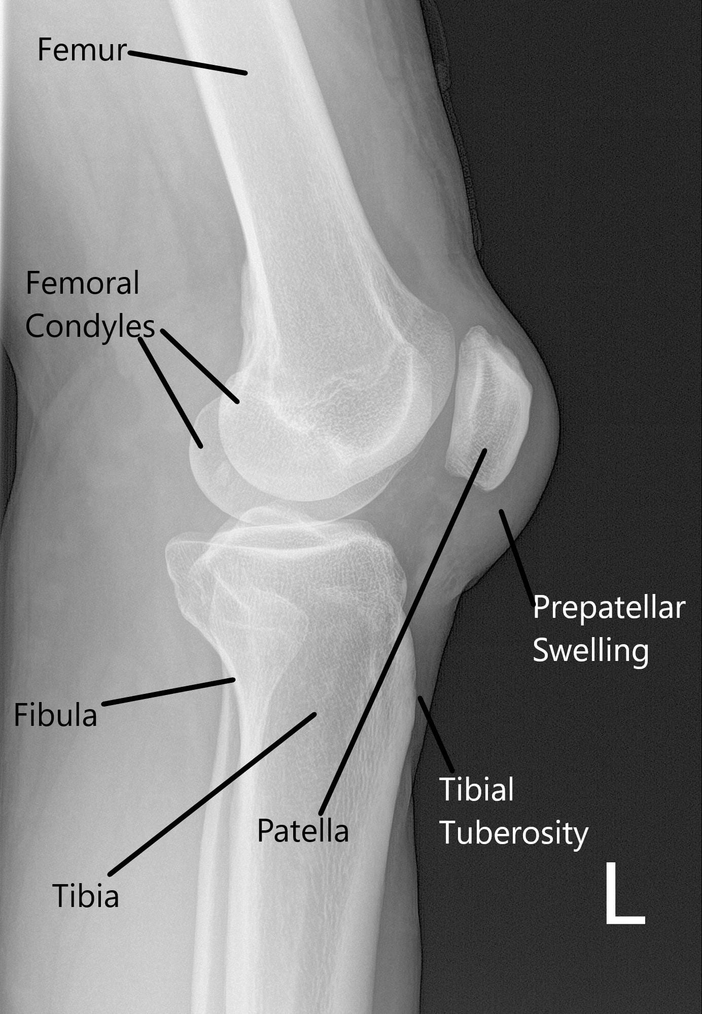 X-ray of the left knee in lateral view