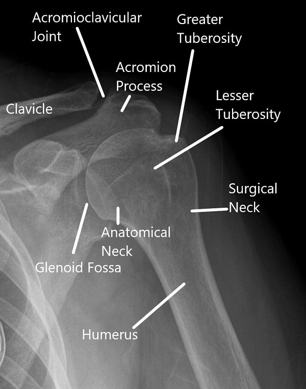X-ray of the shoulder in AP view. X-ray of the shoulder in AP view