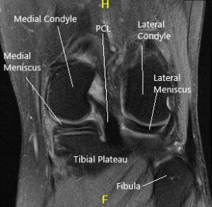 Resonancia magnética de la rodilla en secciones sagital y coronal