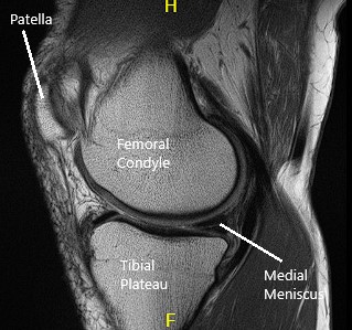 Resonancia magnética de la rodilla en secciones sagital y coronal 2