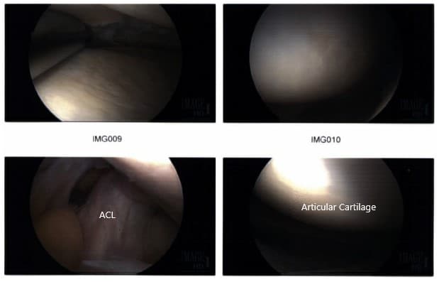 Imágenes artroscópicas intraoperatorias 