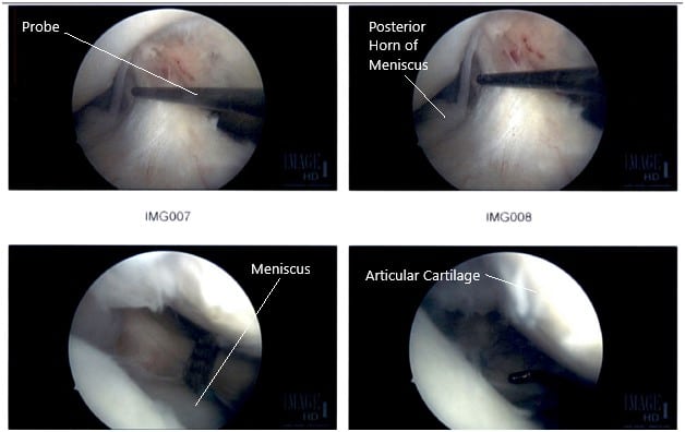 Imágenes artroscópicas intraoperatorias de la rodilla derecha