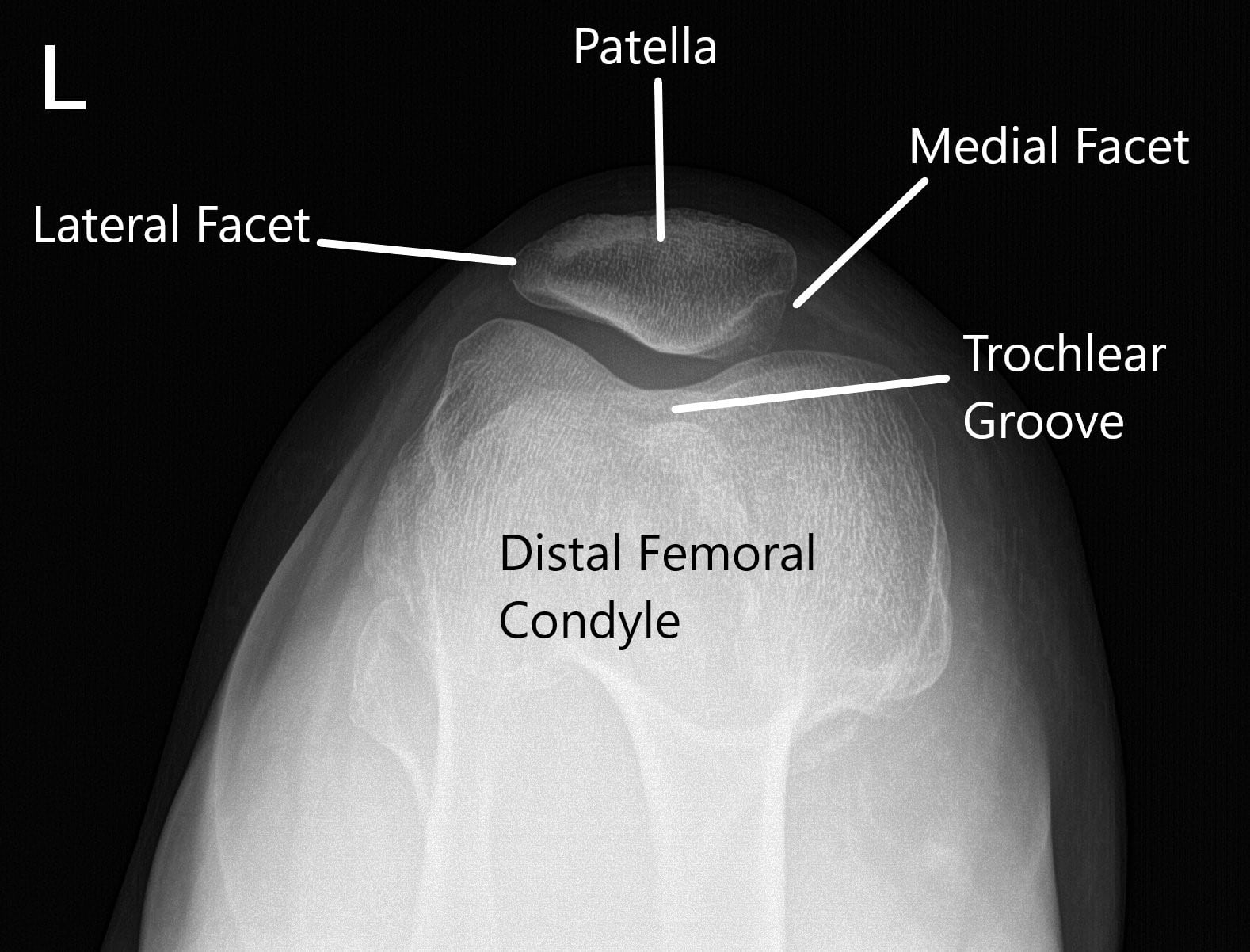 Radiografía de la rodilla izquierda en AP y vista del horizonte de la rótula 2